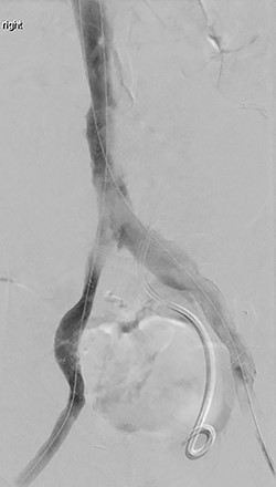 Completion venogram after recanalization and stenting.
