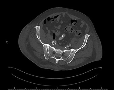 Postoperative computerized tomography angiogram with an arrow demonstrating likely point of compression of left EIA by venous stent.