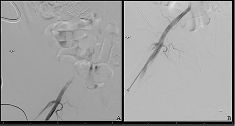 (A) Shows initial retrograde angiogram of right common femoral artery with occlusion at the level of the EIA. (B) demonstrates restoration of flow postangioplasty and stenting.