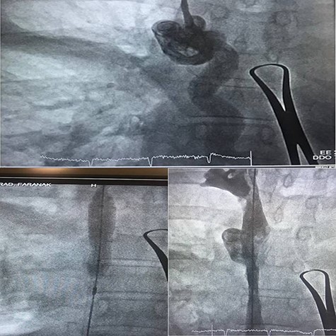 Balloon venoplasty to open SVC stenosis.