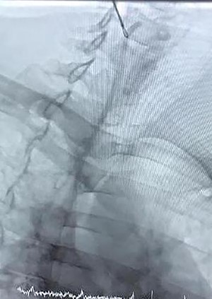 Snare-technique retrieval of chemo port catheter.