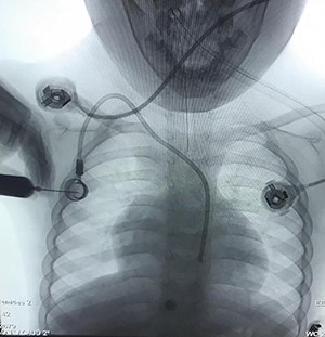 Chemotherapy port catheter in the carotid artery of a 5-year old child.