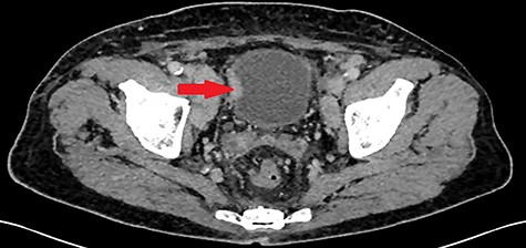 Thickening of the right lateral wall of the bladder enhancing at arterial time on CT scan (arrow).