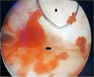 Peroperative appearance during cystoscopy before resection. Star: healthy bladder mucosa. Arrow: bullous inflammatory lesion that was resected.