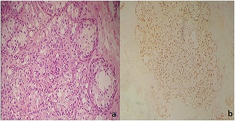 (a) Carcinomatous proliferation consisting of globular cells with abundant eosinophilic cytoplasm and a large nucleolus (HE ×250). (b) Diffuse nuclear staining of tumor cells by anti-TTF1.