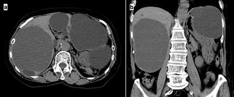 Preoperative CT imaging demonstrating multiple large liver cysts in the bilateral liver lobe and compression of the stomach due to a large cyst (a: axial section, b: coronal section).