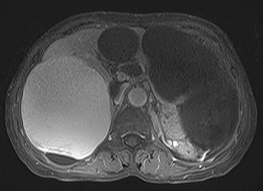 Preoperative T1-weighted magnetic resonance imaging showing different findings in the right and left lobe cysts.