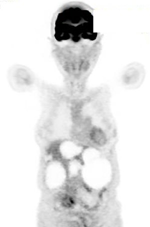 Positron emission tomography-CT showing no increase in 18F-fluorodeoxyglucose metabolism in the liver cysts.
