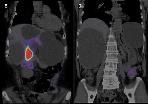 Hepatobiliary scintigraphy with CT highlighting only the gallbladder, with no biliary communication with the liver cysts.