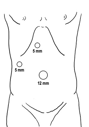 Trocar placement.