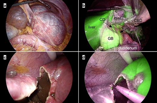 Intraoperative laparoscopic images. (a) The large cysts in the left lateral lobe can be seen compressing the stomach; (b) Indocyanine green fluorescence is observed in the liver parenchyma and biliary tracts but not in the cyst wall. Abbreviations: CBD, common bile duct; CD, cystic duct; GB, gallbladder; (c and d) The cyst wall is cut precisely at the cyst–liver boundary under the guidance of white light (c) and ICG fluorescence imaging (d).