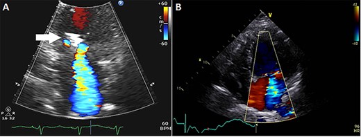 (A) Echocardiogram showing mitral clip (white arrow) at 4 months after clip placement; (B) at 7 months, left ventricular ejection fraction was 15–20%, diastolic and systolic diameters were 54 and 51 mm, respectively, and mean transmitral gradient 2.1 mmHg.