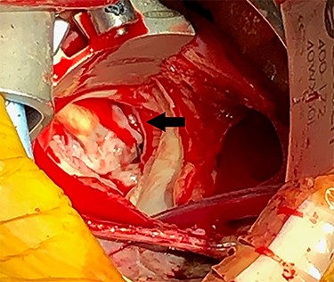 Intraoperative mitral valve with mitral clip (black arrow).