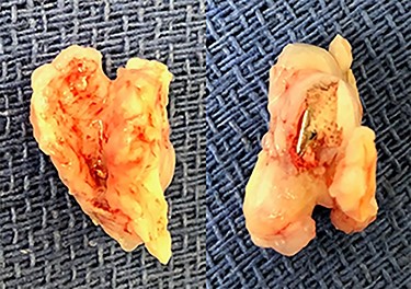 Two explanted mitral clips attached to partial leaflets.
