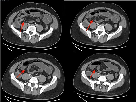 CT abdomen/pelvis showing SBO with transition point in right lower quadrant.