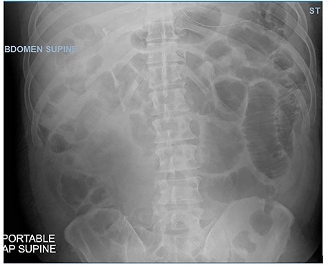Abdominal X-ray showing dilated loops of bowel on Day 9 of admission.