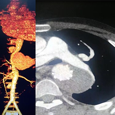 (A) CTA of the left subclavian aneurysm (right), (B) CTA of thoraco abdomen aneurysm (left).