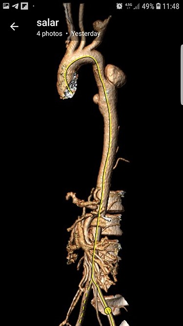 Preoperative CTA.