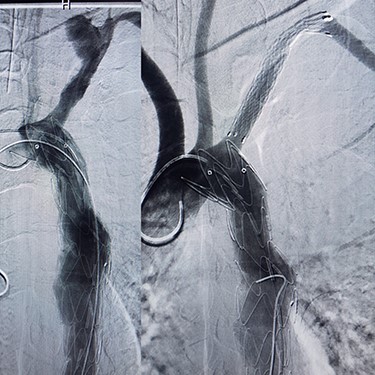 (A) Angiography after stent-graft placement of left subclavian (right), (B) thoracic aorta (left).