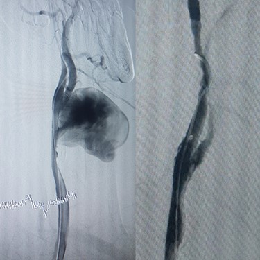 (A) Carotid angiography before stent-graft placement (left), (B) after stent-graft placement (right).