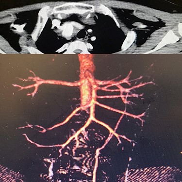 (A) Infra renal aortic thrombosis (down), (B) right subclavian aneurysm (up).
