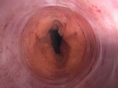 Endoscopic visualization of circumferential amyloid protein deposition causing urethral luminal narrowing.