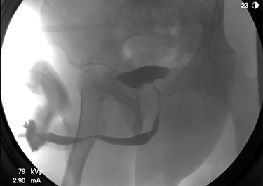 RUG demonstrating focal urethral stenosis of the penile urethra during preoperative investigation.
