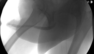 Postoperative imaging demonstrating a well-healed urethral anastomosis with excellent patency.