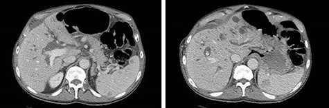 CT of the abdomen and pelvis demonstrating severe intrahepatic and extrahepatic biliary ductal dilation and multiple splenic hemangiomas.