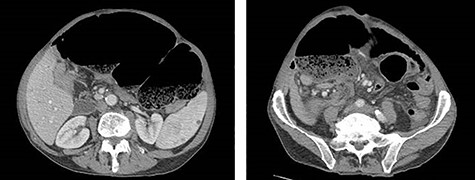 CT of the abdomen and pelvis demonstrating coffee-bean shaped cecum in left upper quadrant dilated to 12 cm, consistent with cecal volvulus.
