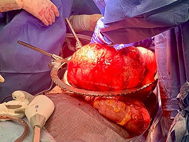 Intraoperative picture of cecal volvulus.