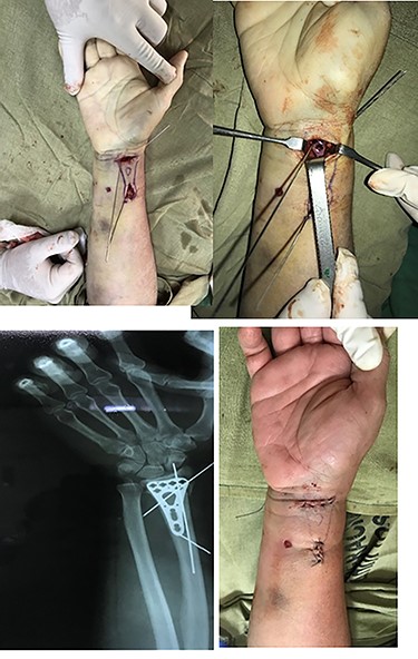 T shape incision. (a) The forearm with the two incisions. (b) Visualizing the plate. (c) X-ray visualizing the correct position of the plate. (d) Both incisions sutured.