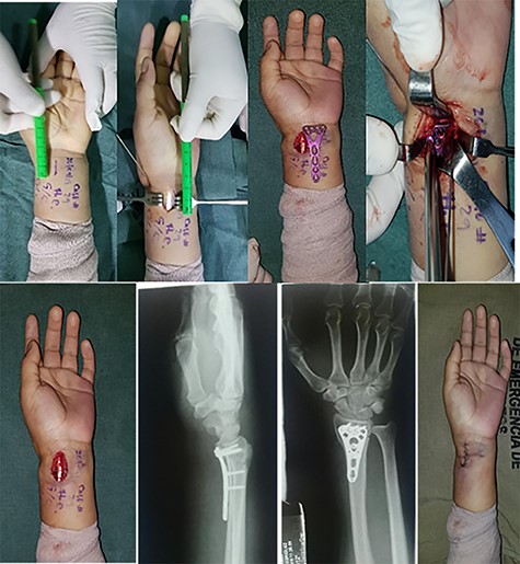 Longitudinal I shape incision. (a) Measurement of the incision. (b) The I incision. (c) The plate over the forearm. (d) Introducing the plate inside the forearm. (e) The forearm with the plate introduced. (f) Lateral X-ray of the wrist. (g) Anteroposterior X-ray of the wrist. (h) The incision already sutured.