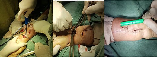 Double-incision longitudinal II. (a) Double incision with the plate already introduced in the forearm. (b) Verification of the osteosynthesis in the radius. (c) Both incisions already sutured