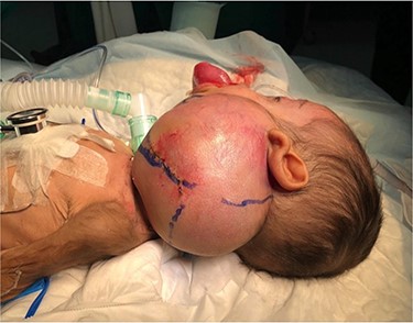 Presentation of the infant to our center.