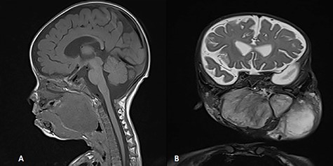 MRI, (A) sagittal view, showing the mass with extension into pharynx and oral cavity pushing the tongue base, (B) coronal view, the mass involving the neck, parapharyngeal space and pharynx up to base of skull.