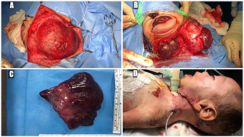 (A) trans-cervical approach, (B) trans-oral/trans-cervical excision of the mass, (C) post-excision size (12 × 12 cm) and (D) the patient post-operatively.