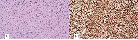 (A) monomorphic spindle cell fibroblastic proliferation with myxoid background (hematoxylin and eosin stain (20×)), (B) diffuse nuclear staining of B-Catenin.