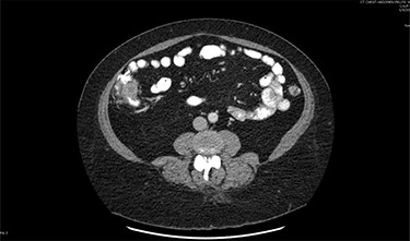 Right colon neuroendocrine tumor.