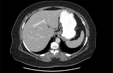 Trajectory of the portal vein, with absent left portal vein.