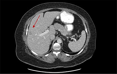 Portal vein and liver metastasis to segment 5.