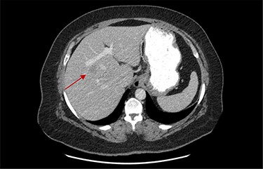Portal vein surrounding liver metastasis in segment 7.