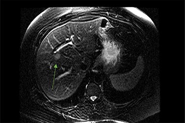 MRI image again demonstrating segment 5 metastatic lesion in close proximity to portal vein.