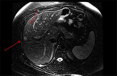 MRI demonstrating segment 7 metastatic lesion.