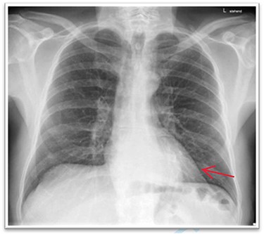 Thoracic X-ray with retrocardiac mass.