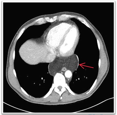 CT showing hypodense mass in the lower posterior mediastinum.