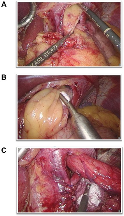 (A) The oesophageal hiatus with herniation of the greater omentum; (B) Careful withdrawal of the omentum from the oesophageal herniation; (C) After omental reposition, the distal oesophagus was repositioned and a dorsal crurorhaphy performed.
