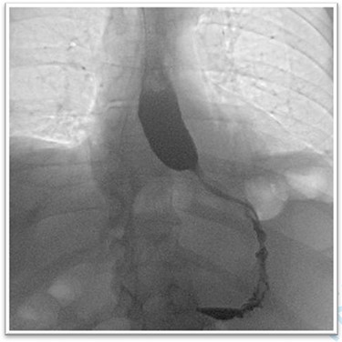 The barium oesophagogram showing a near to total stenosis caused by alimentary bolus.