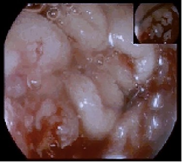 Upper endoscopy showing an ulcerative and friable duodenal lesion.