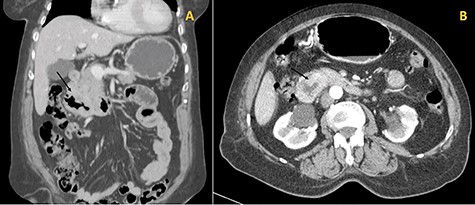 (A) Coronal cut of the abdomen on CT showing the third portion of the duodenum visibly thickened (arrow); (B) Arterial phase showing the circumferential involvement of D3 (arrow).